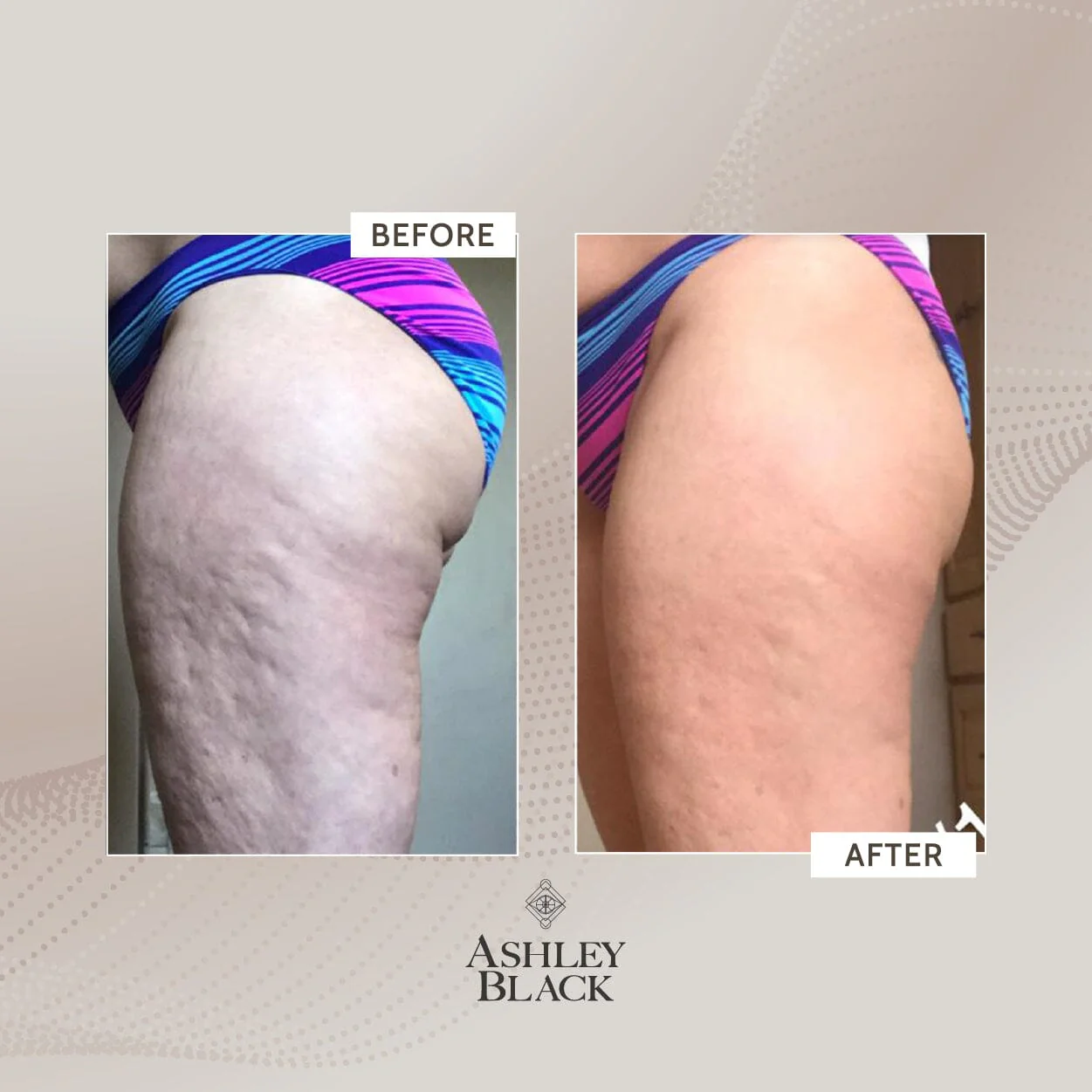 BigDaddy FasciaBlaster® - Image 5